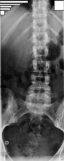 Radiografía AP Lumbar